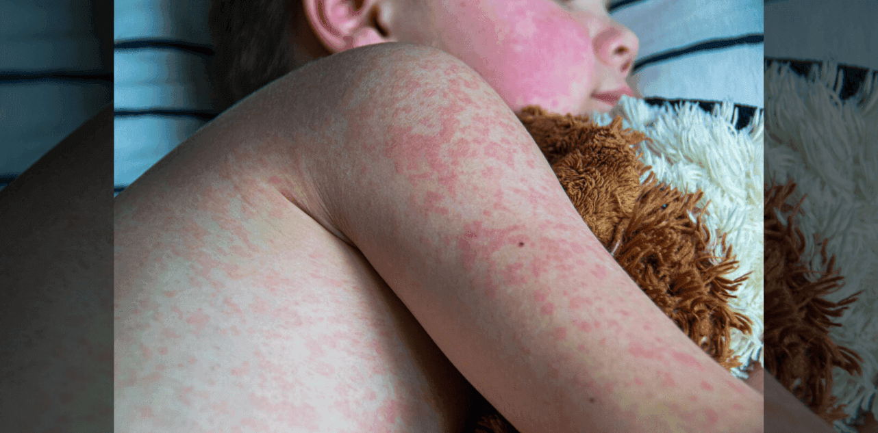 Measles