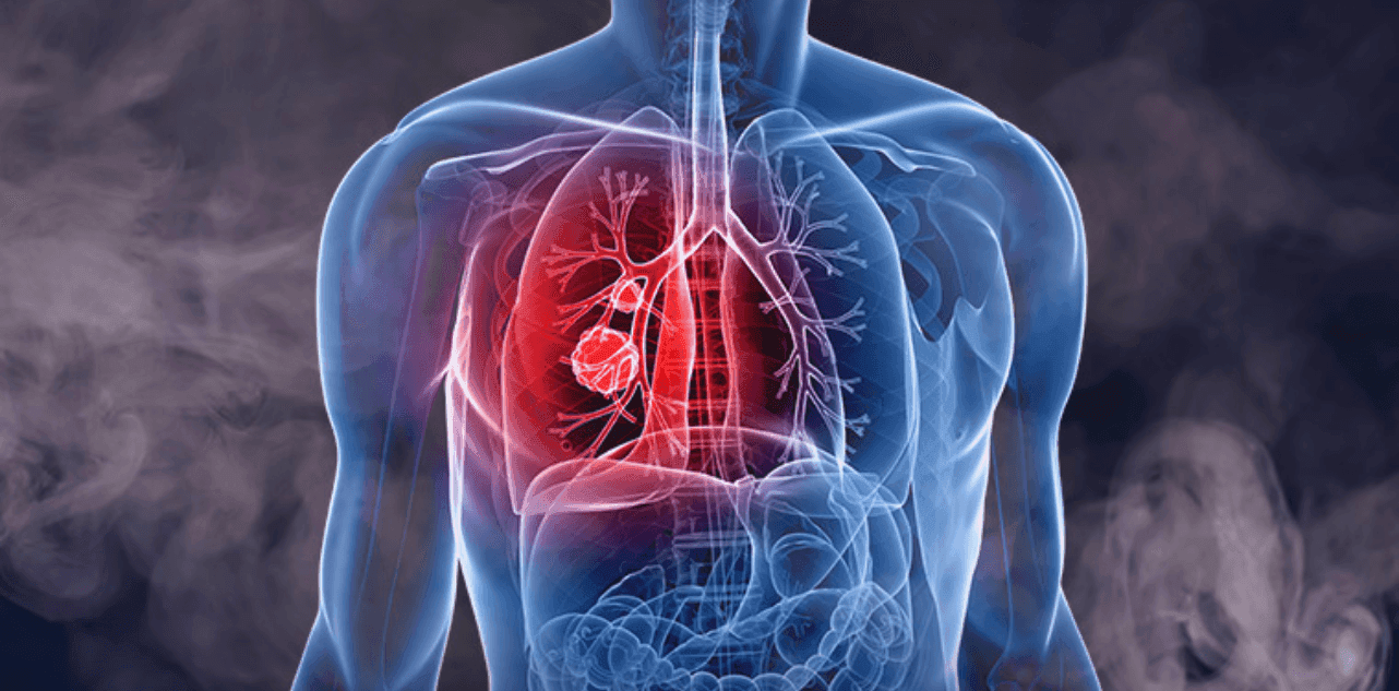 lung cancer in non‑smokers
