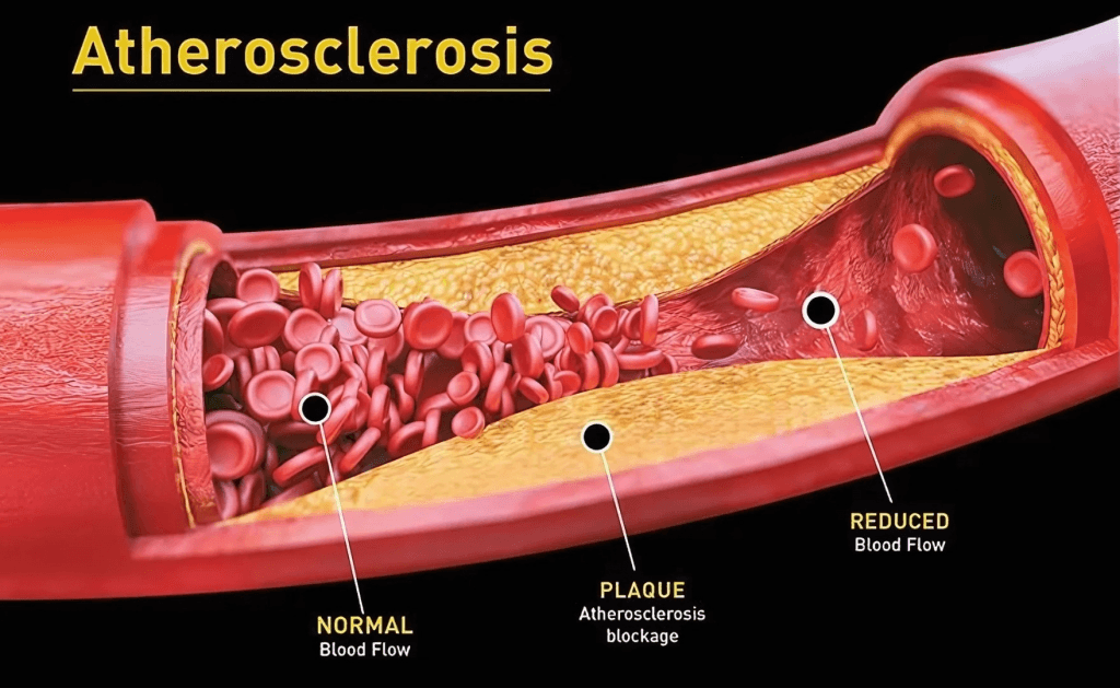 Atherosclerosis