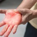 Guillain-Barr Syndrome